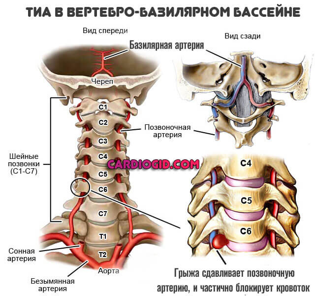 ТИА-в-вертебробазлярном-бассейне