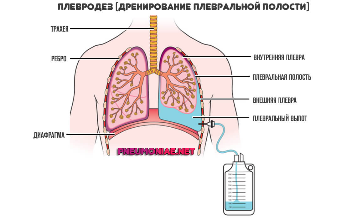 дренирование-плеврального-выпота