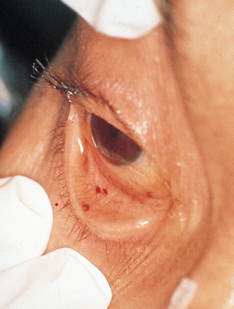 кровоизлияние при жировой эмболии