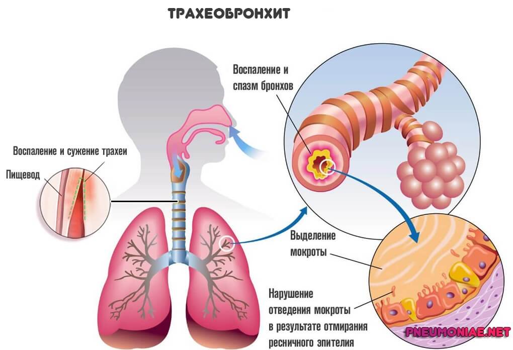 трахеобронхит у взрослого