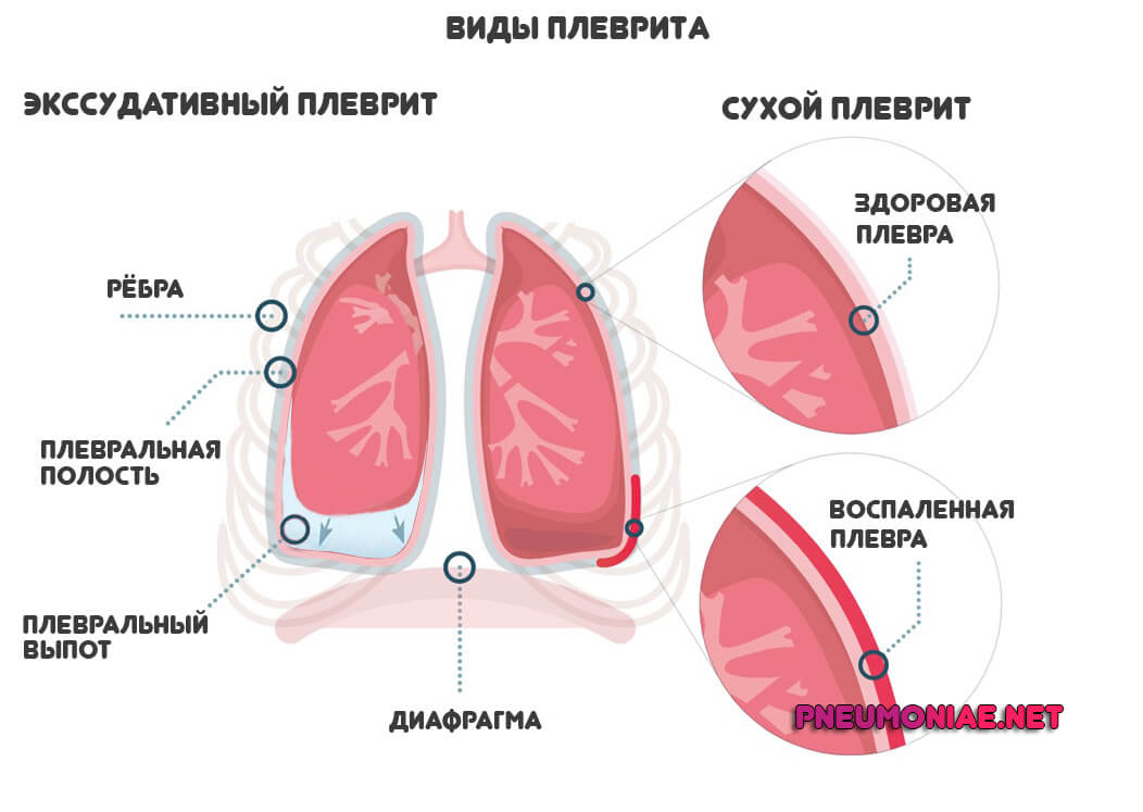виды-плеврита