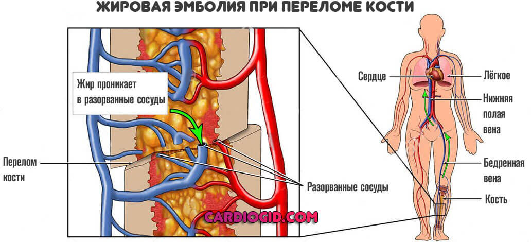 жировая-эмболия-при-переломе