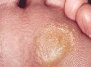 Как избавиться от натоптышей народными методами и в клинике