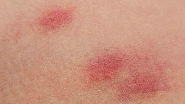 Аллергия может возникать как при наружном применении средства, так и при употреблении его внутрь. Аллергия может возникать как при наружном применении средства, так и при употреблении его внутрь.